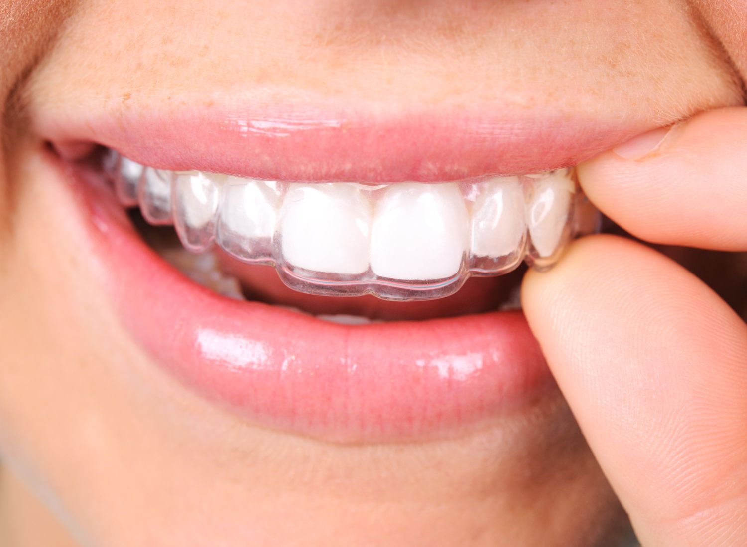 Patient fitting a clear retainer on teeth for alignment maintenance at AMC Dental in London.