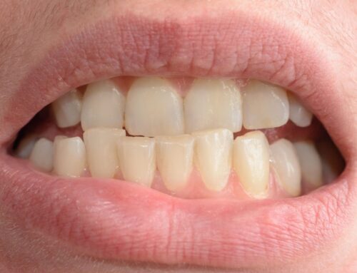 Why Crooked Teeth Make Flossing Harder on Mondays